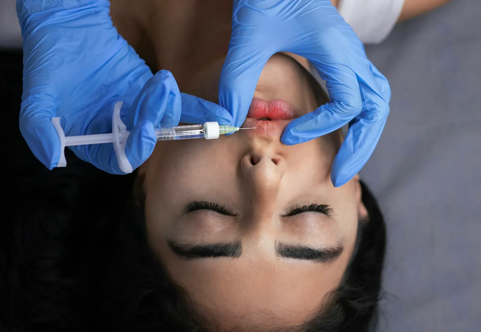 Profissional de luvas aplicando preenchimento nos lábios de uma paciente deitada de olhos fechados